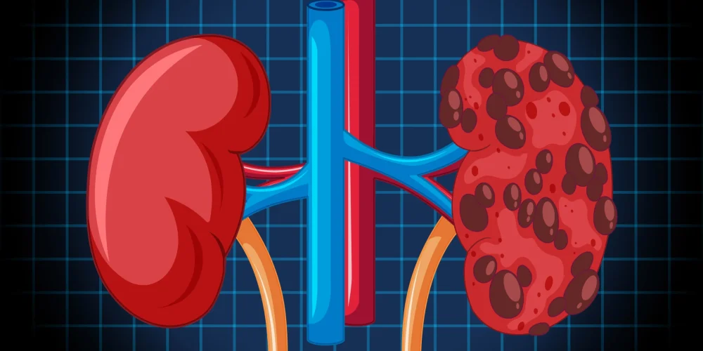 Healthy Kidneys